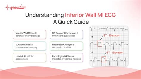 Understanding Inferior Wall Mi Ecg A Quick Guide