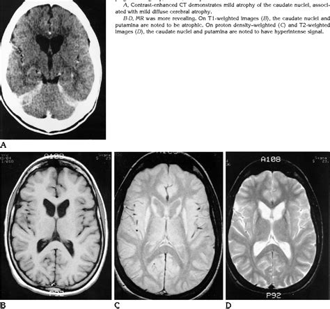 Table 1 From Juvenile Huntington Disease CT And MR Features