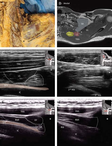 The Cadaveric Model For The Muscles Attaching To The Medial Scapular