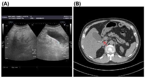 Microorganisms Free Full Text Acute Calculous Cholecystitis Caused