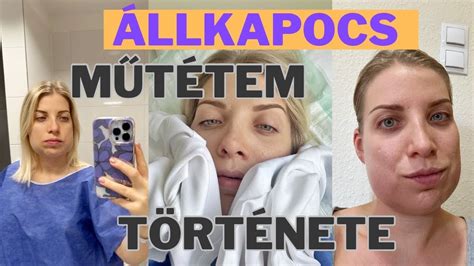 Állkapocs Műtét Előtte és Utána YouTube