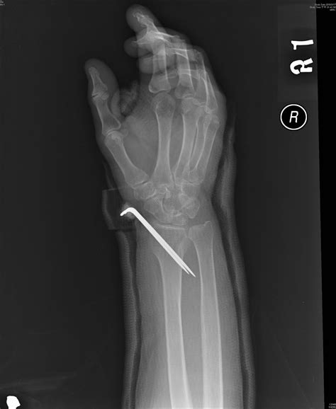 Big Bad: 65 y/o female patient: distal radius fracture pinning cast