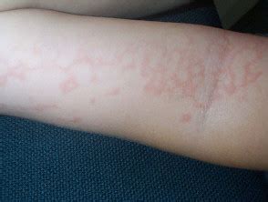 Im Genes De Erythema Infectiosum Dermatly El Sitio De Tu Piel