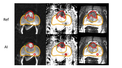 Improving Breast Cancer Detection In Ultrasound Imaging Using Ai