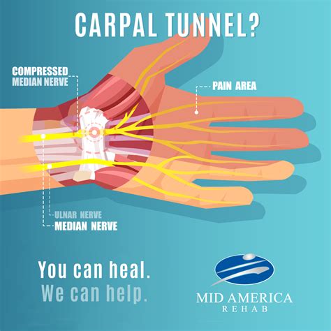 Carpal Tunnel Strengthening Exercises