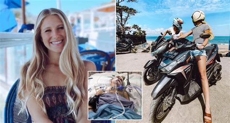 Bali Tourist Suffers Brain Injury In Horrific Scooter Accident