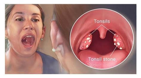 Effective Ways To Remove Tonsil Stones Without Surgery Healhty And Tips