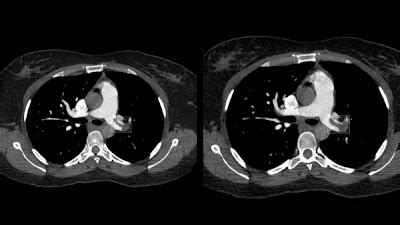 Radiology Artificial Intelligence On Twitter The RSNA Pulmonary