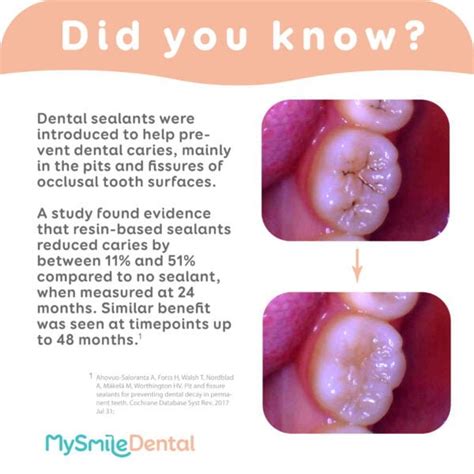 Dental Sealants MySmile Dental Clinic