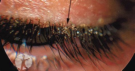 Pediculosis Image