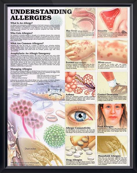 Understanding Allergies Chart 20x26 Most Common Allergies Allergies