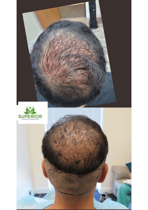 Non Surgical Hair Restoration Health Wellness