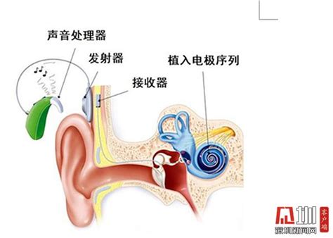 11月龄女婴双侧植入人工耳蜗 龙岗区耳鼻咽喉医院帮助患儿重回有声世界深圳新闻网