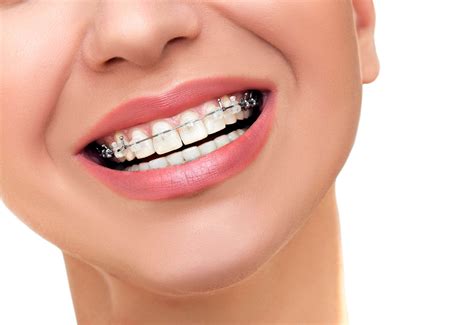 Retainer Instructions - Smile Suffolk Braces | Suffolk, VA | Orthodontist