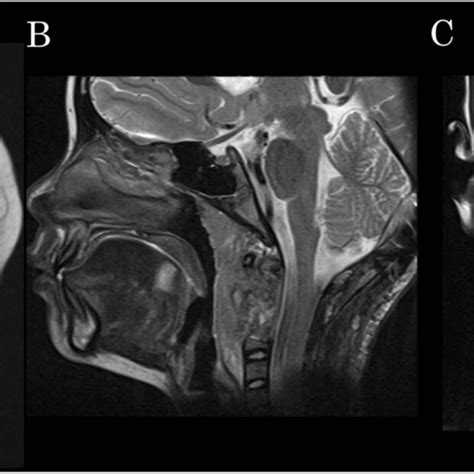 Postoperative Magnetic Resonance T Weighted Imaging Axial A