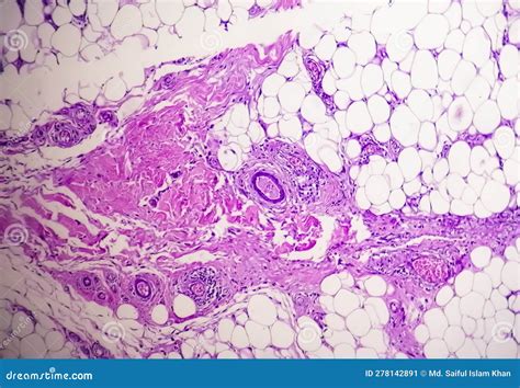 Granulomatous Tissue Histology Showing Foreign Body Granuloma Stock