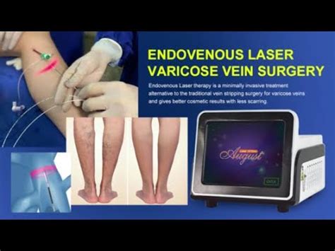 Nm Evlt Varicose Vein Laser Treatment Evla Surgery Equipment