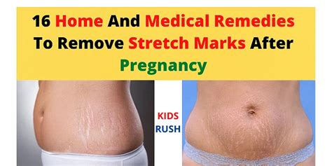 16 Home And Medical Remedies To Remove Stretch Marks After Pregnancy