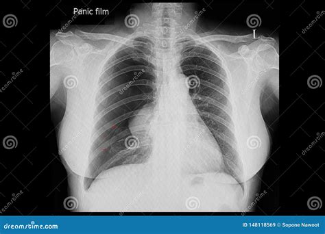 Chest X Ray Film Of A Patient With Pneumothorax Stock Image Image Of