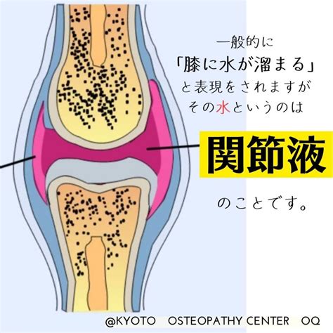 変形性膝関節症 今さら聞けない 膝に水がたまるってどういうこと？ 京都オステオパシーセンターoq