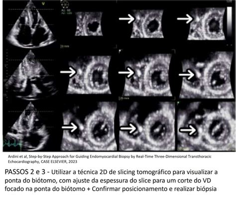 Ecocardiograma Transtorácico 3D na Biópsia Endocárdica ganho em