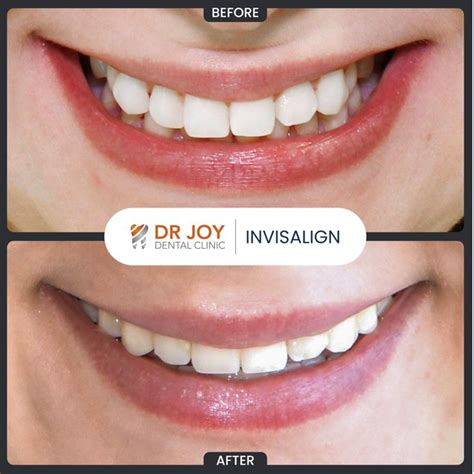 Dr Joy Dental Clinic Dubai On Linkedin Drjoydentalclinic