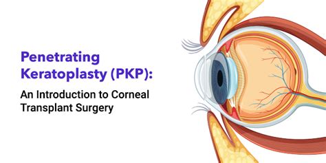 Corneal Transplant Surgery Restoring Vision With Keratoplasty