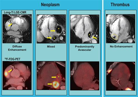 Late Gadolinium Enhancement Cardiac Magnetic Resonance Tissue