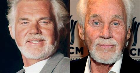 Kenny Rogers Botox And Nose Job - Before And After Surgery