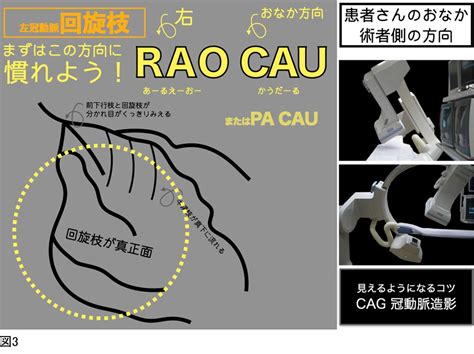 心カテまるわかり冠動脈造影を見るコツ①知れば怖くない わたしがカテに参加するカテスタッフも病棟スタッフも心臓のはなしをしましょうか