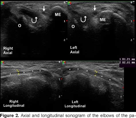 Figure 2 From Cubital Tunnel Syndrome Caused By Hypertrophic Burn