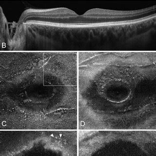 Multimodal Imaging In Case 4 Structural Optical Coherence Tomography