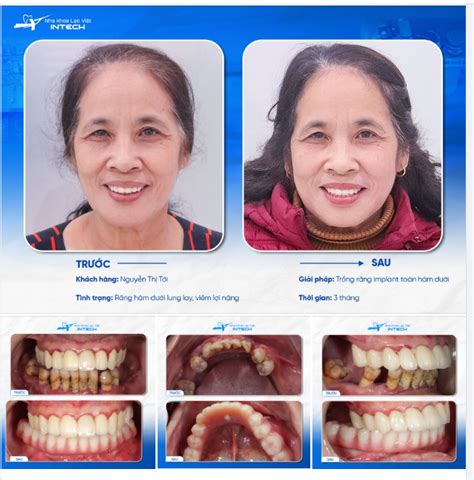 TRỒNG RĂNG IMPLANT CÔNG NGHỆ DCT THỎA ƯỚC NGUYỆN ĂN NHAI TRỌN VẸN CỦA