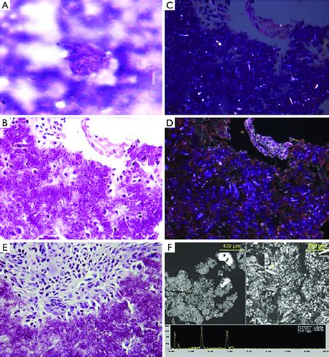 Cytopathologic Findings On Cppd Depositions A Aggregate Of Crystals