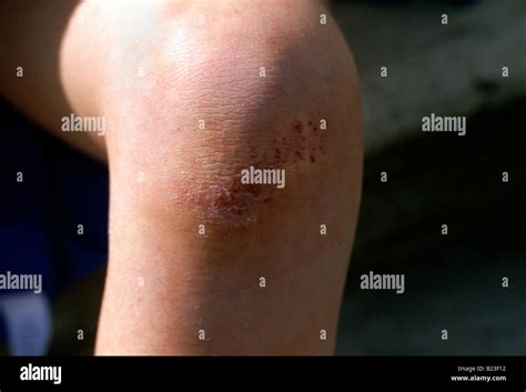 Grazed Injury Hi Res Stock Photography And Images Alamy