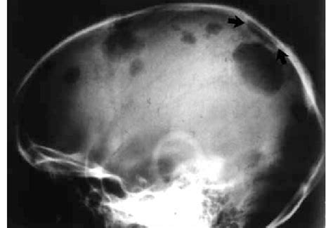 Skull Radiograph Shows Multiple Well Demarcated Lytic Lesions Note Download Scientific Diagram