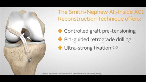 Ultrastar Single Tendon Acl Reconstruction Technique With Ultrabutton