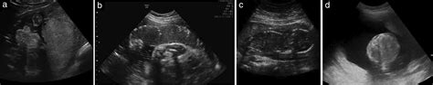 Isuog Practice Guidelines Role Of Ultrasound In Congenital Infection