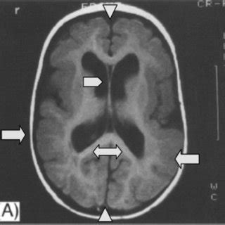 Cobblestone Lissencephaly