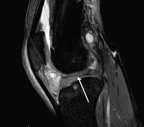 Localized Anterior Arthrofibrosis Of The Knee That Occurs After