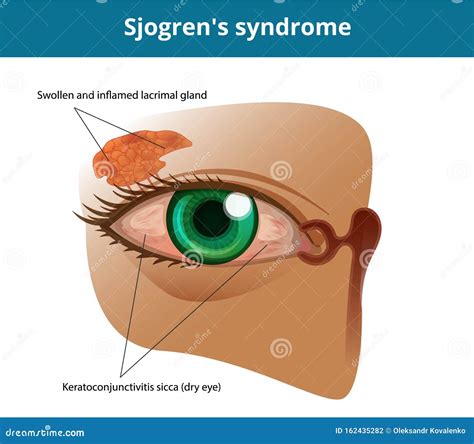 Sjogren`s Syndrome Or Dry Eye Syndrome Keratoconjuctivitis Sicca Stock