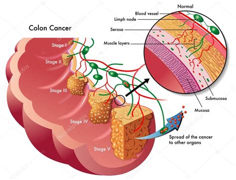 Colon Cancer — Stock Vector © Rob3000 60338355