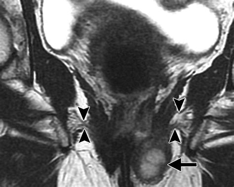 Imaging Of The Female Perineum In Adults RadioGraphics