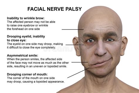 Facial Palsy in a Man, 3D Illustration Highlighting the Asymmetry and ...