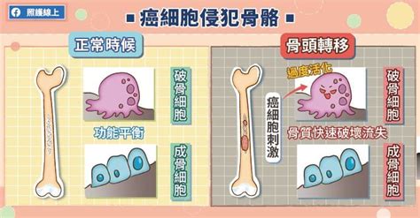 輕微碰撞就骨折？4大癌症常見「骨轉移」 骨頭痛別輕忽 祝你健康 三立新聞網 Healthsetncom