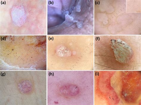 Vaginal Warts