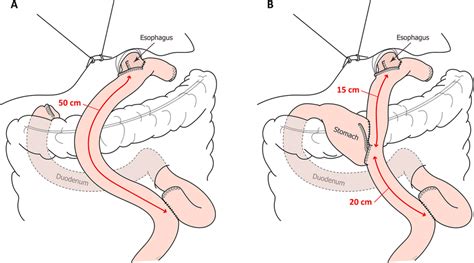 Partial Gastrectomy