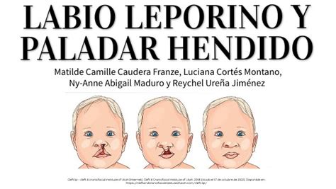 Labio Leporino Y Paladar Hendido