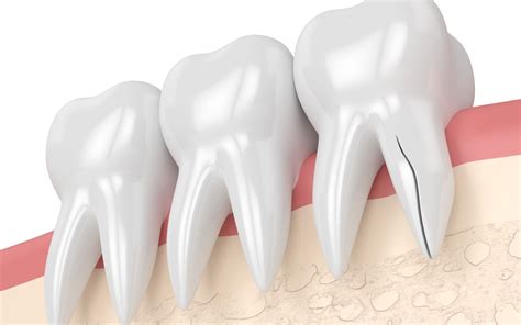 Understanding Vertical Root Fractures Diagnosis And Treatment At Raleigh Endodontics Raleigh