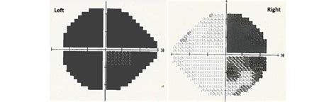 Humphrey S Visual Field Test Results Left Visual Field Index Vfi Of